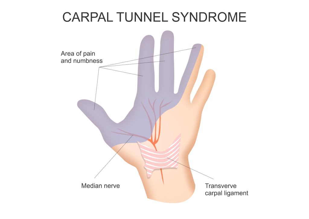 carpal tunnel syndrome symptoms, carpal tunnel syndrome surgery, ring finger