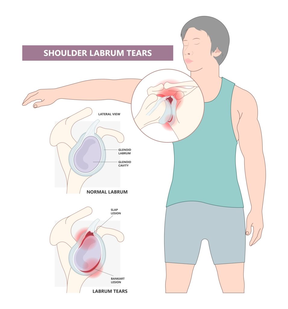 shoulder labral tears, ball and socket joint, biceps muscle